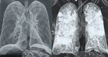 Prognostication of COVID-19 on CT-Scans